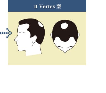 Ⅱ Vertex型