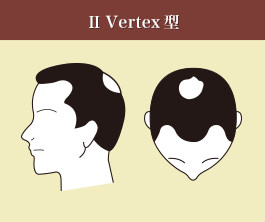 Ⅱ　Vertex型