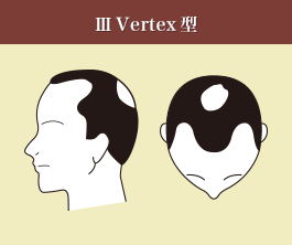 Ⅲ　Vertex型
